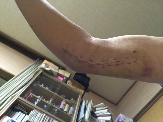 くっつきたての傷